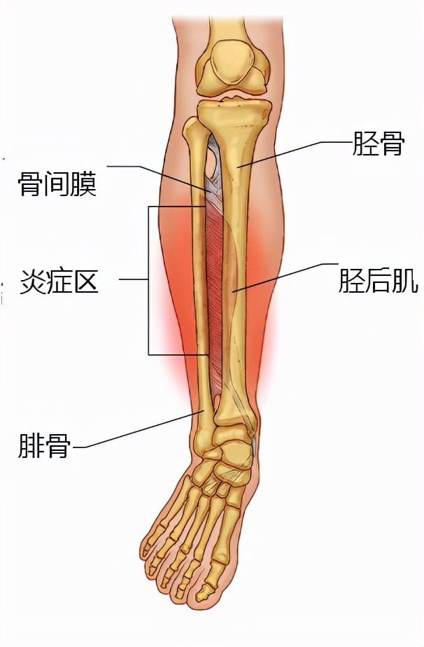 儿童胫骨疼痛一招立马缓解,孩子前胫骨中间疼痛怎么解决