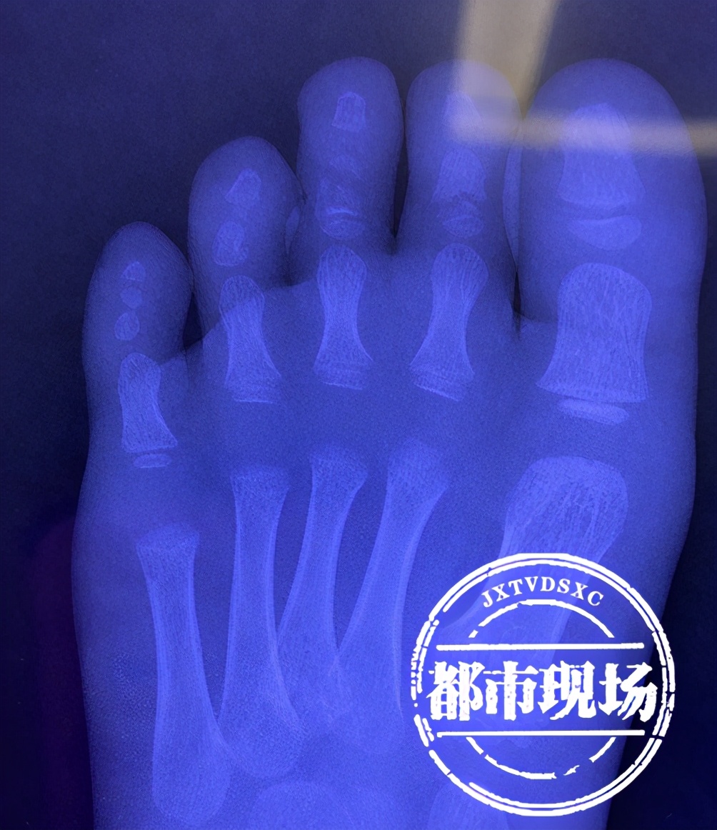 男孩脚被石头压伤,南昌三岁男童搬石头砸自己脚