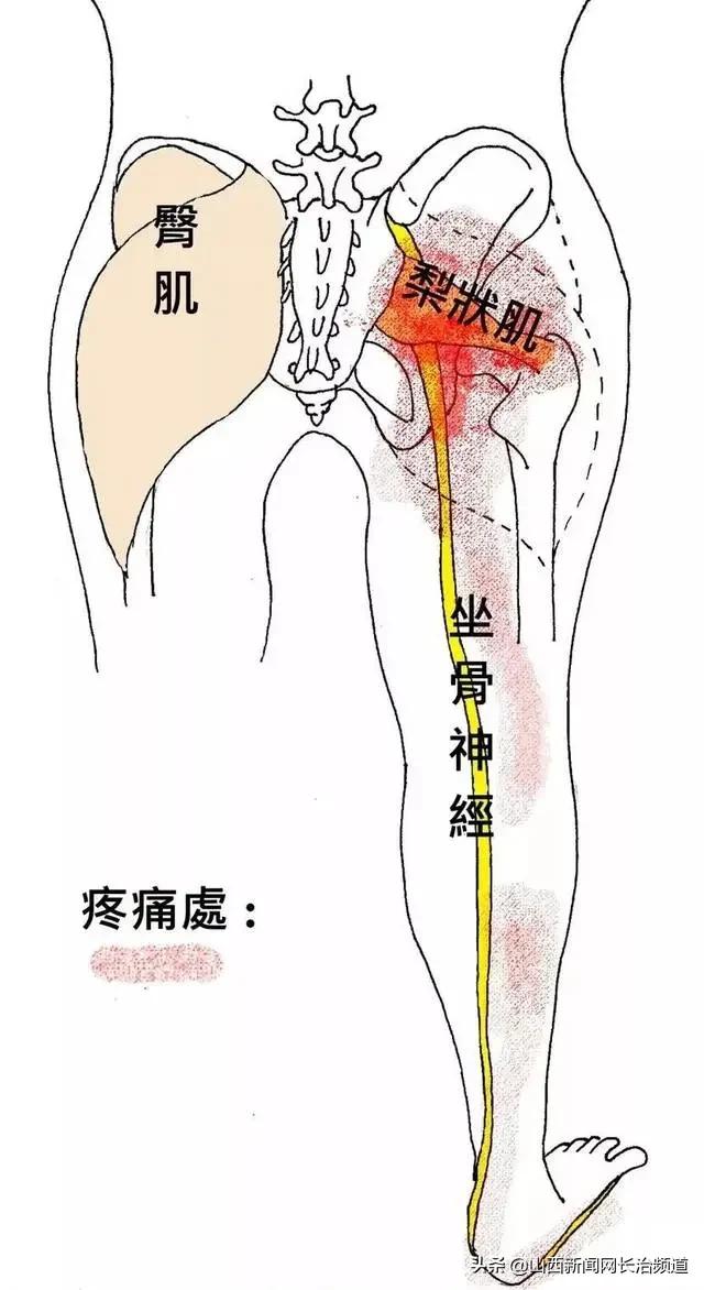 产后梨状肌疼痛怎么治疗,产后一侧屁股连着腿疼