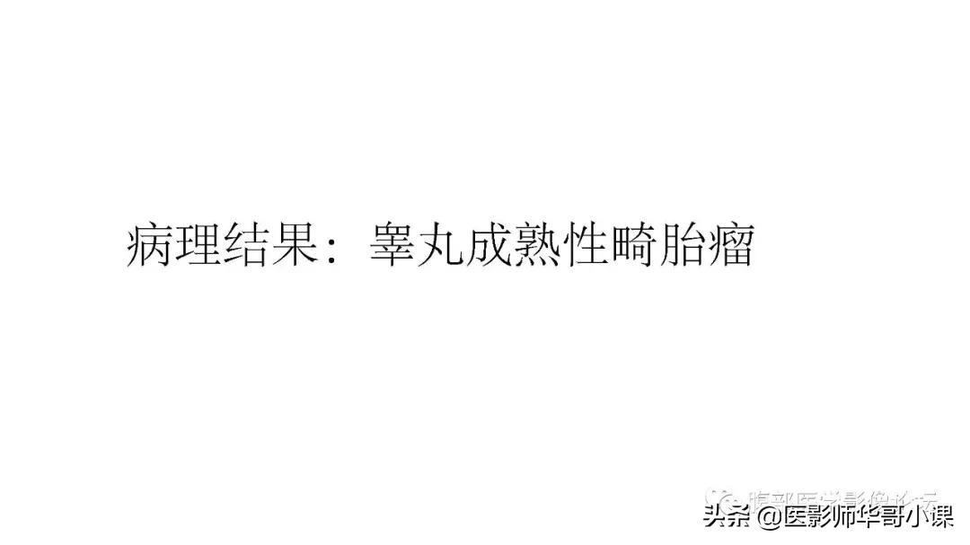 [精品课件]畸胎瘤及精原细胞瘤（*丸睾**肿瘤及肿瘤样变CT及MR表现）