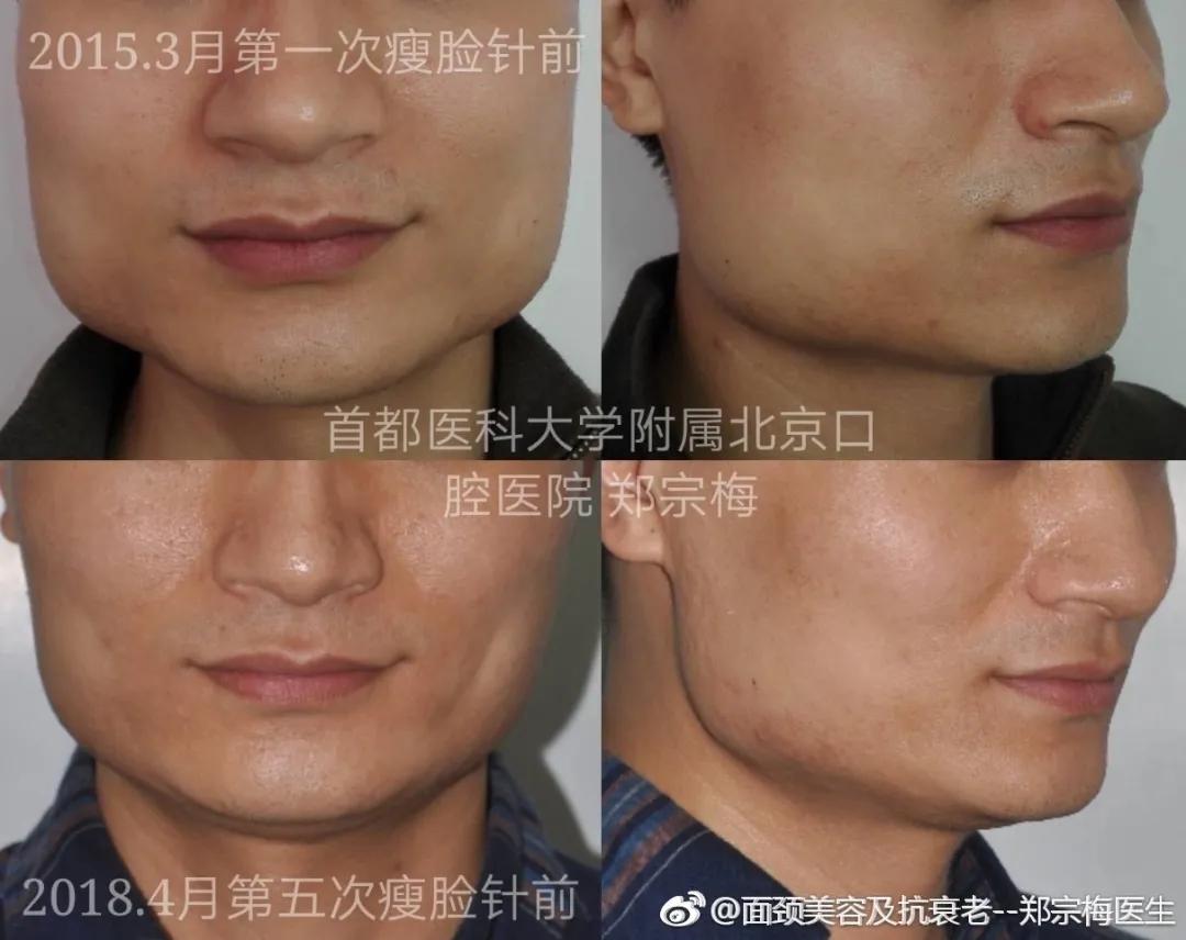 解密瘦脸针的几大常识性问题,关于瘦脸针的几个常识问题