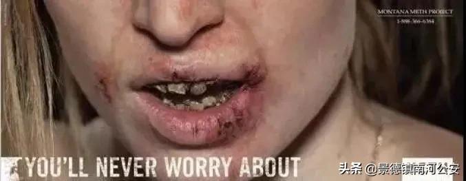 “我的笑容就像是一个空洞！”22岁女子吸毒6年，瘦到脸凹牙拔光…