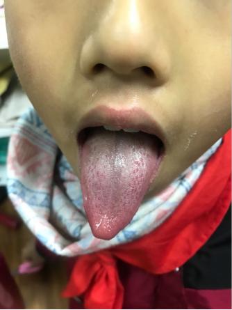 积食湿疹反复发作怎么办,积食引发的湿疹怎么处理