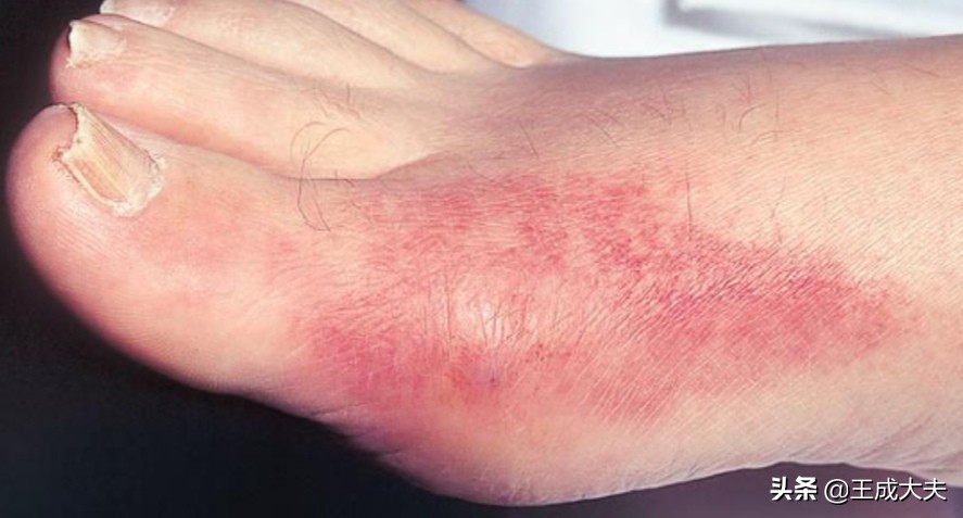 我在美国治痛风颠覆国人的想象,美国说2030有望攻克痛风