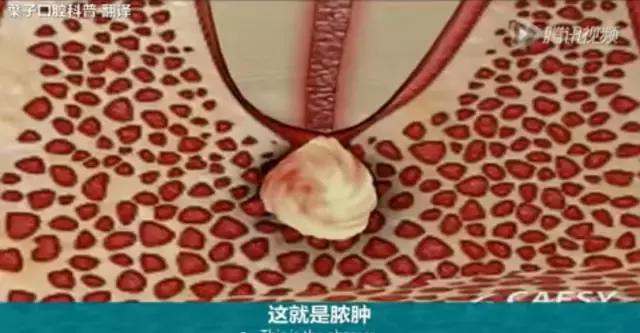 上牙龈上火突出一个鼓包,牙龈肿胀鼓包上火了吗