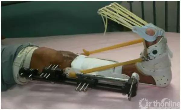 外固定支架训练方法,外固定支架拆除后怎么护理