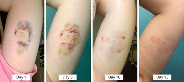 在美国做手术,在美国做什么避孕手术