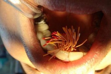 牙齿蛀牙怎么治疗,治疗蛀牙的视频