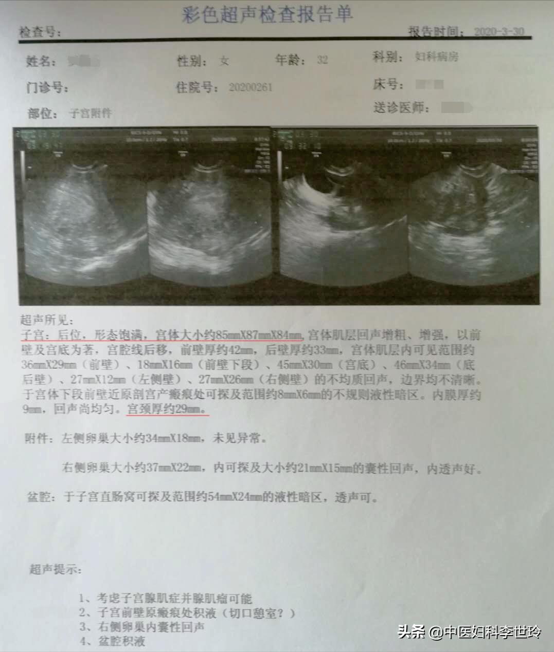 子宫腺肌症淤堵中药调理,根治子宫腺肌症奇效验方