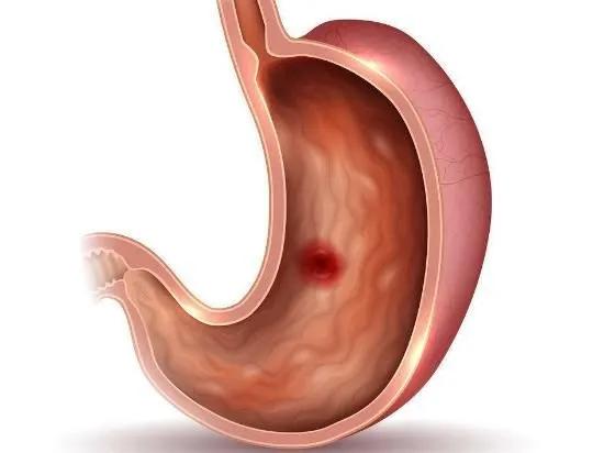 糜烂性胃炎真的是胃烂了嘛,糜烂性胃炎胃食道反流原因