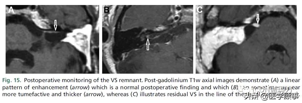 「综述」前庭神经鞘瘤的成像：诊断、监测、和治疗计划