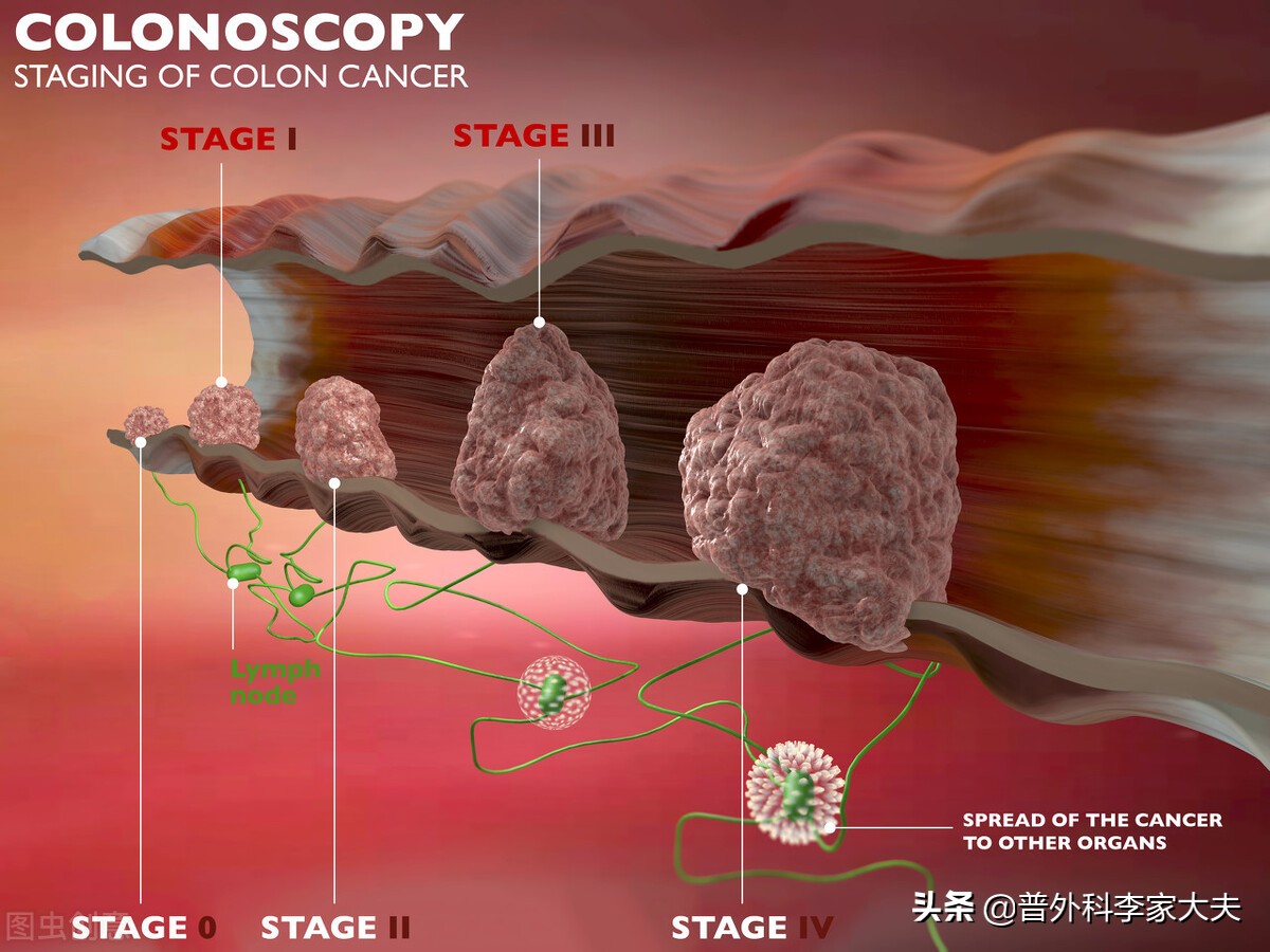 直肠癌手术后吃什么营养恢复更快,直肠癌有什么症状和表现