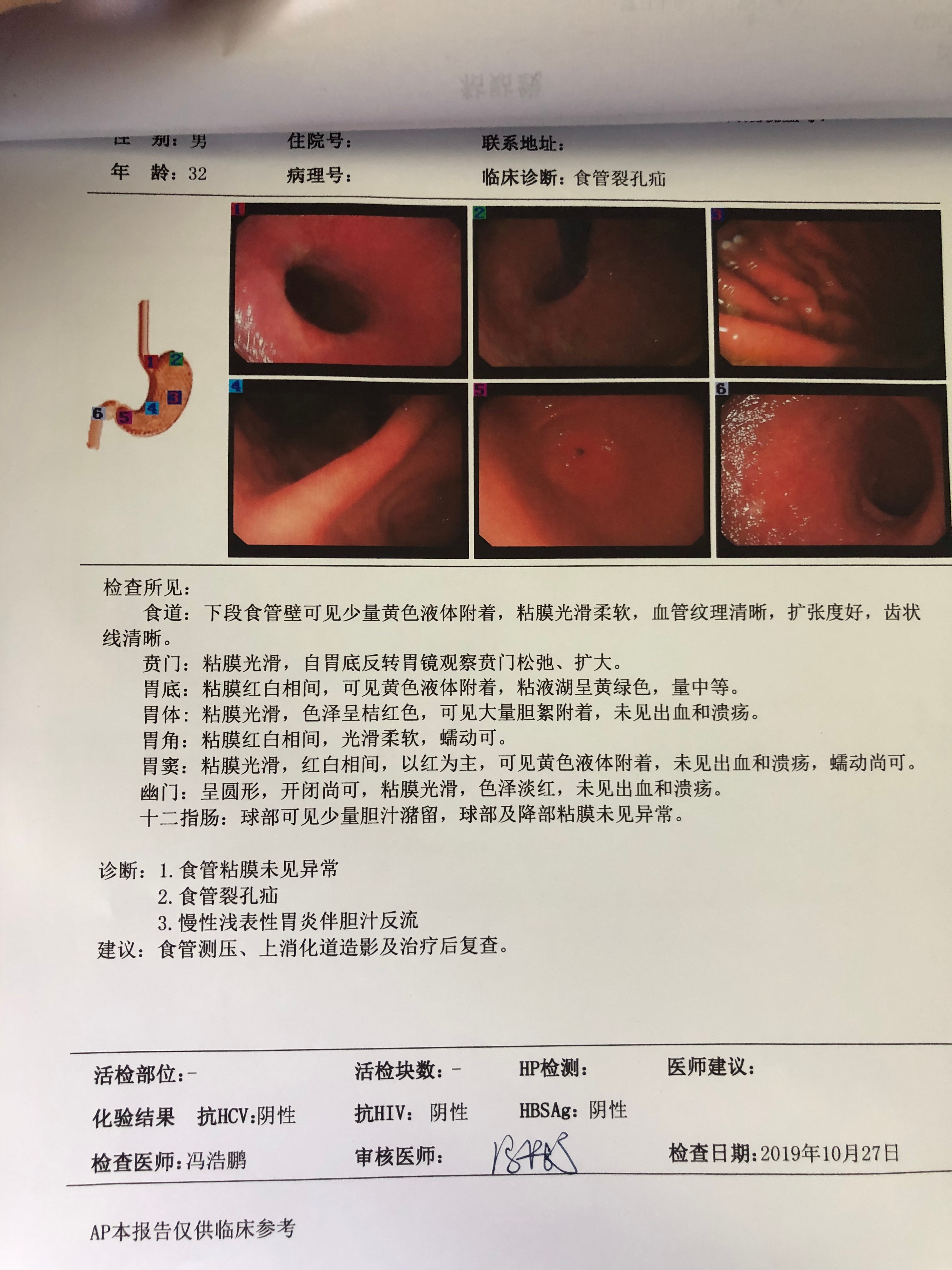 胆囊切除后饭后吐酸水,胆囊摘除后胃胀怎么办