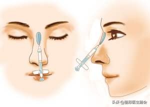 玻尿酸注射隆鼻可以热敷吗,玻尿酸注射鼻子有什么危害