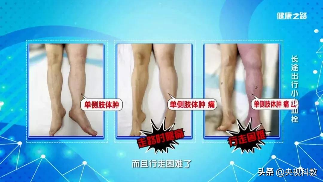 这4类人需尤其当心,肺栓塞会猝死吗