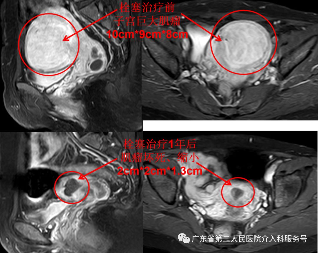 针眼妙方治疗，1个月后让淋沥不净的“大姨妈”如期结束