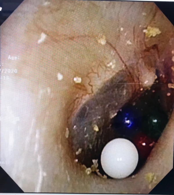 男童误把弹珠卡进鼻孔,男童弹珠塞入耳朵