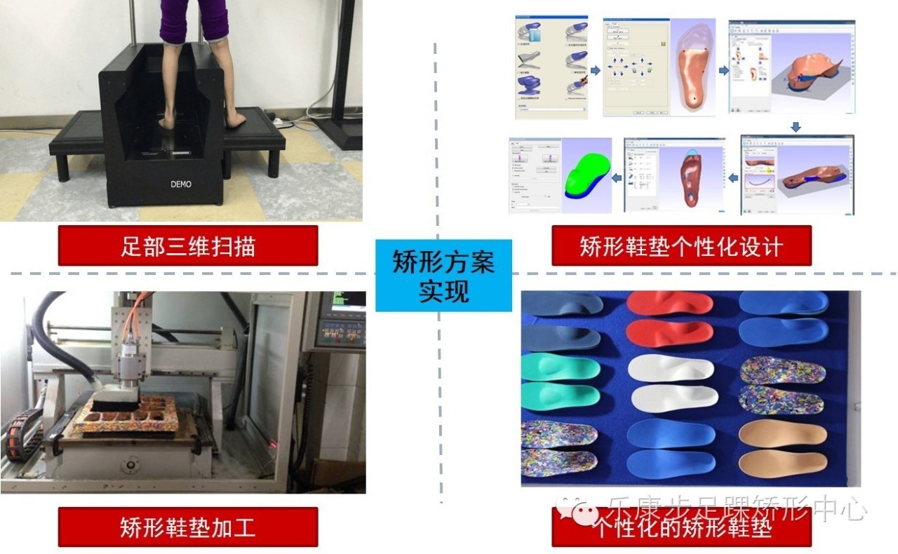 定制矫正鞋鞋垫,定做矫正鞋的地方在哪里