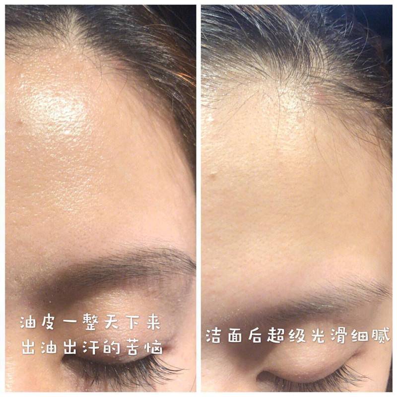 去黑头粉刺最好的建议,真正有效祛黑头粉刺