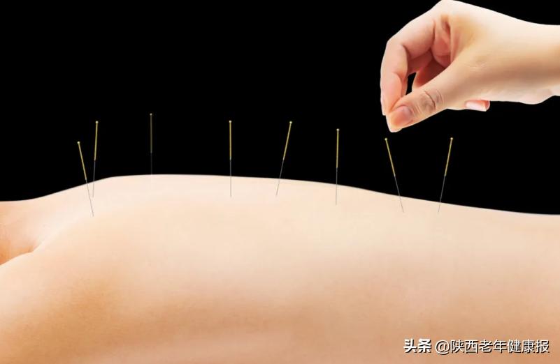 针灸减肥常识大全,减肥不可盲目针灸减肥了解一下
