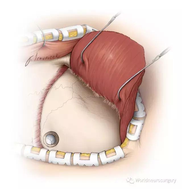 翼点入路的开颅要点,翼点开颅详解图