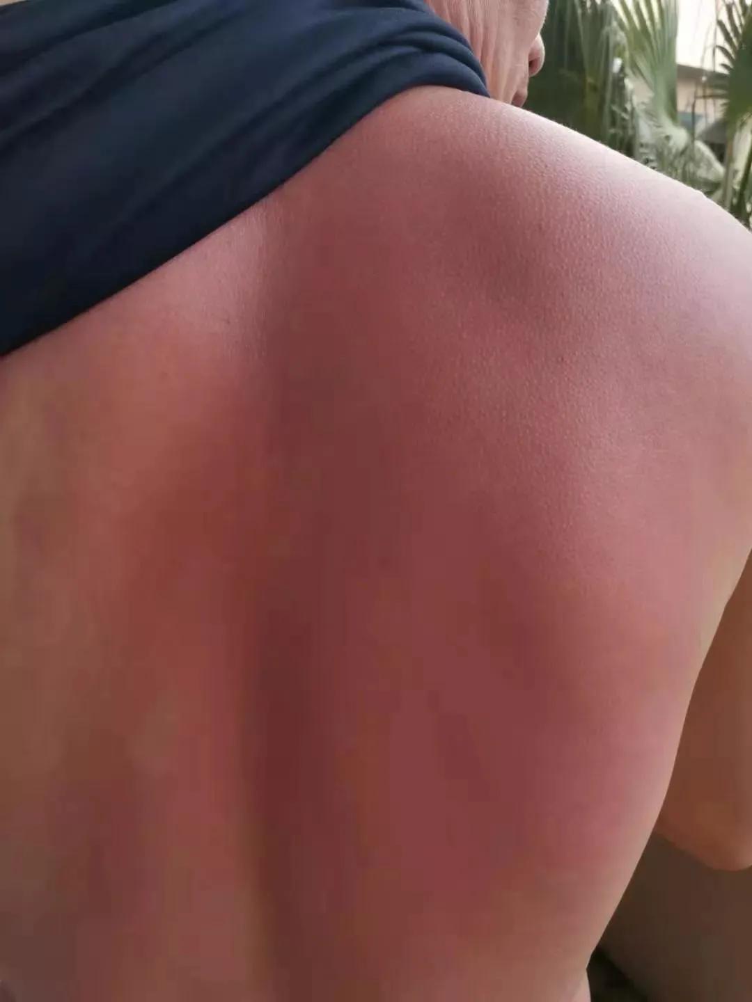 注意！洪水过后，需警惕这些皮肤问题，处理方法来了