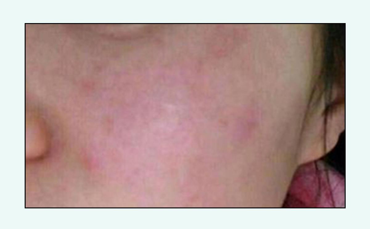 脸上的红疙瘩痒,脸上的红疙瘩用什么药膏