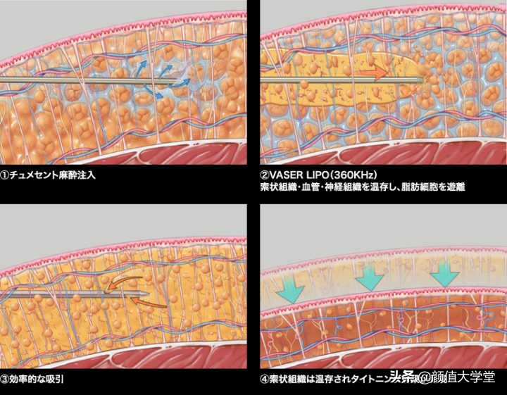 抽脂和吸脂后有什么注意事项,吸脂手术的危害和后遗症