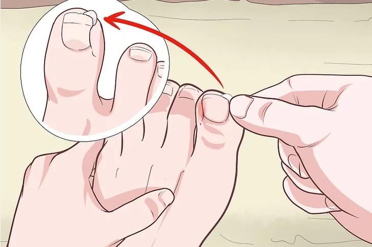 脚趾甲从根往上翘着长怎么处理,脚趾甲弯曲向下生长怎么修