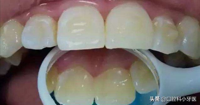 门牙马上要掉了怎么办,门牙连根掉了时间长还能安上吗