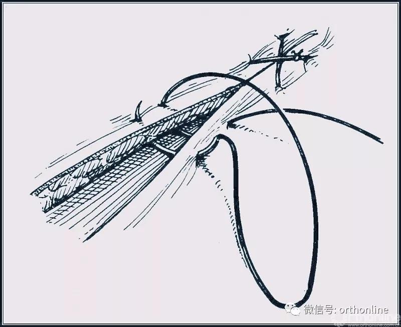 常用的手术缝合方法图,临床常见常用伤口缝合方法