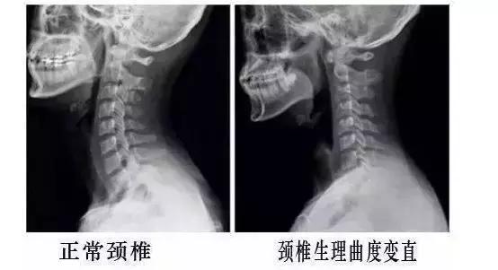 低头颈椎疼头晕如何缓解,科普头晕是怎么回事