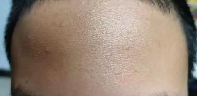 屏障受损起闭口粉刺多长时间能好,不要小看了闭口粉刺