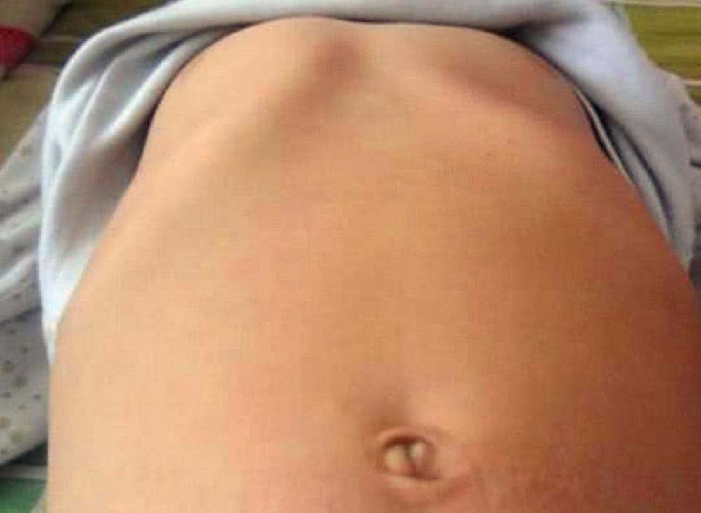 怎样预防孩子鸡胸,导致鸡胸的原因和危害