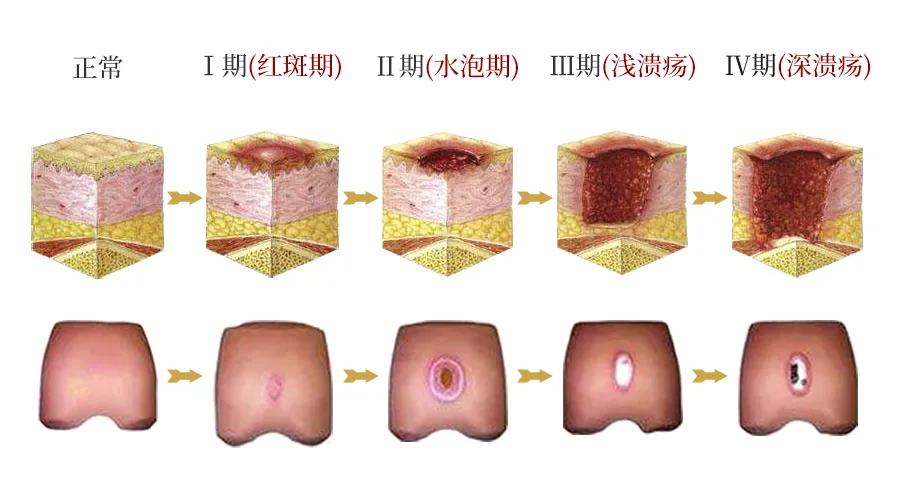臀部褥疮治疗方法,瘫痪老人屁股褥疮怎么治