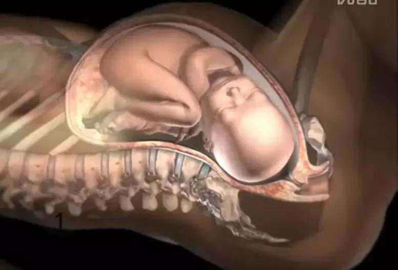 婴儿出生时锁骨骨折自然愈合,刚出生锁骨骨折睡觉姿势