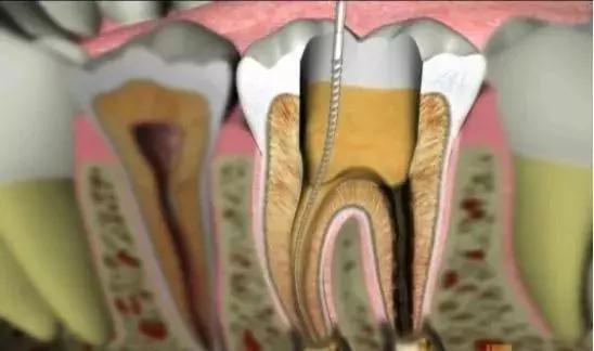 牙齿的普通治疗与根管治疗,根管治疗最严重的牙齿