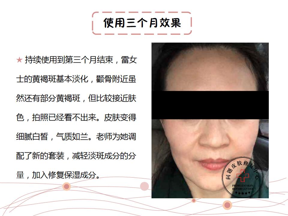 激光祛斑反黑修复过程,激光反黑了怎么修复