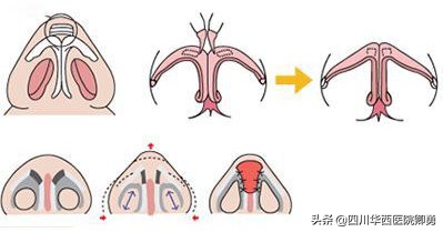 膨体鼻中隔耳软骨隆鼻后遗症,隆鼻后鼻中隔软骨突出怎么办