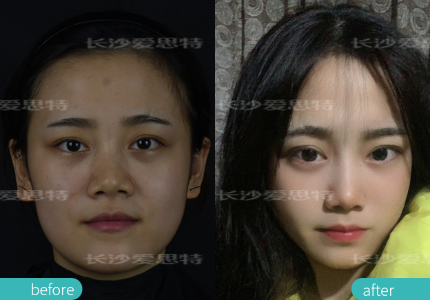 面部雀斑挂哪个科,皮秒嫩肤雀斑