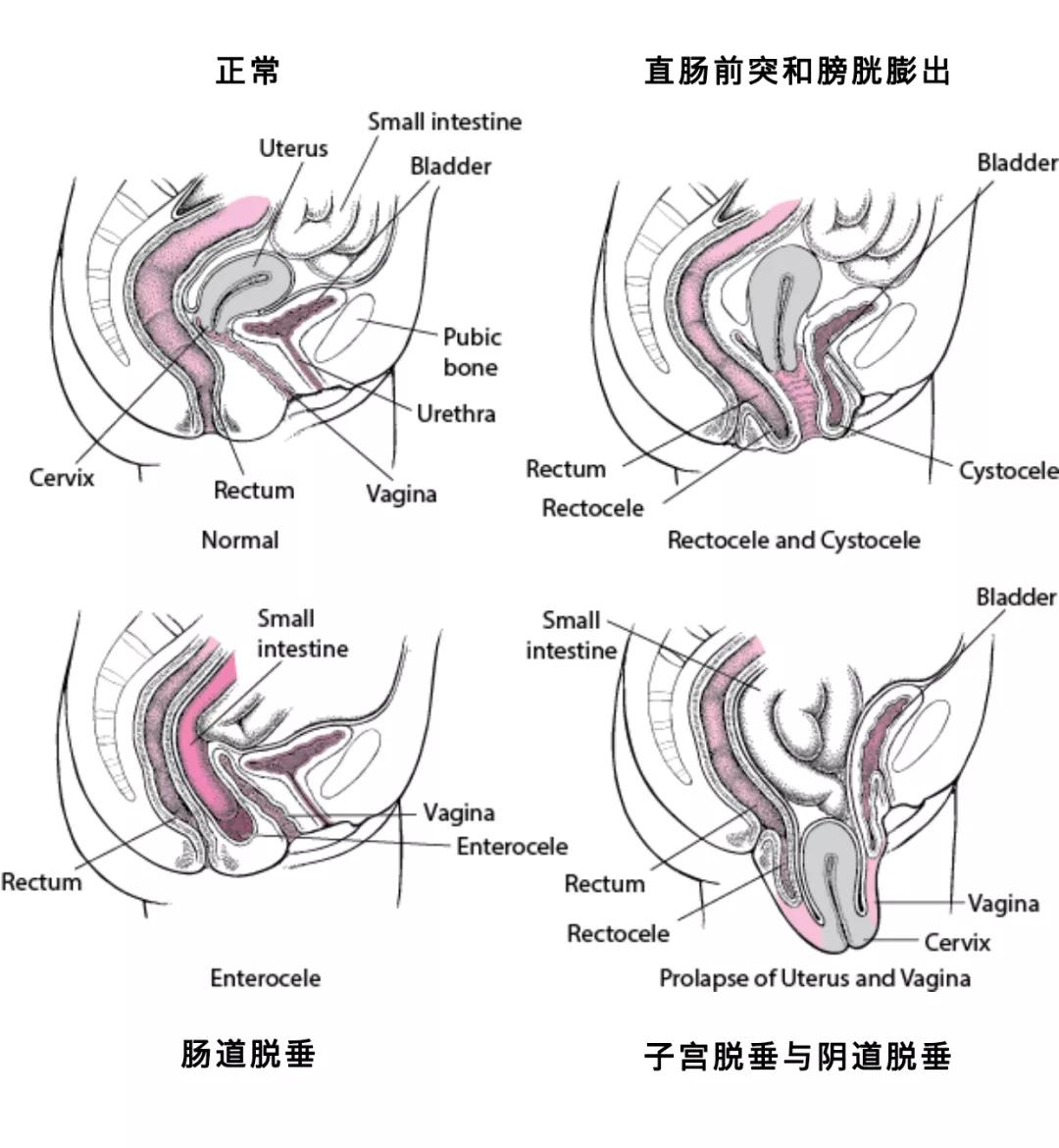 孕产康复|图解盆底肌肌力测试报告
