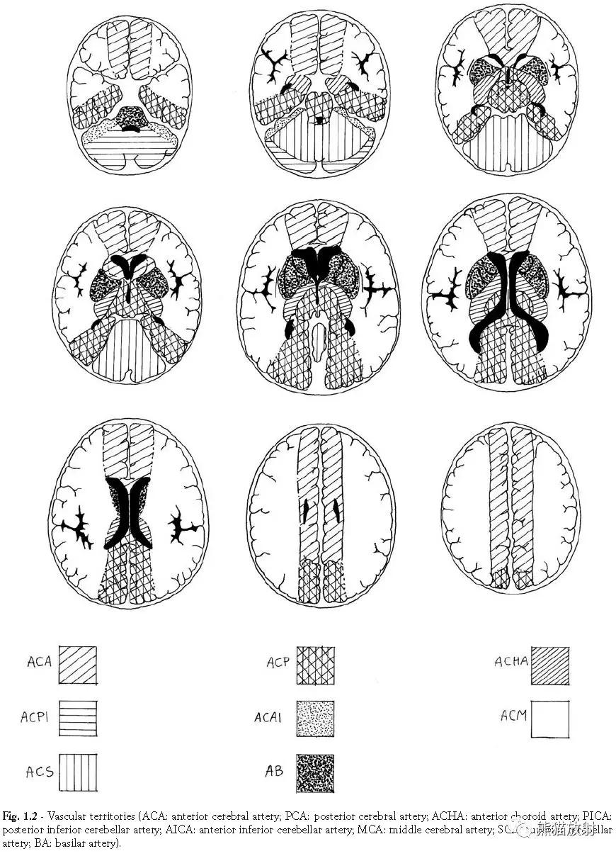 脑梗死丨演变、血供区域分布、CT表现