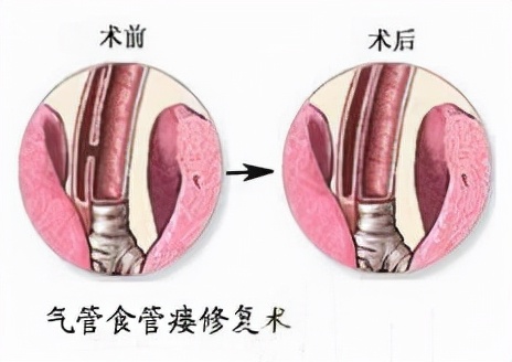 胃食管反流病健康小知识,食管异物的健康宣教