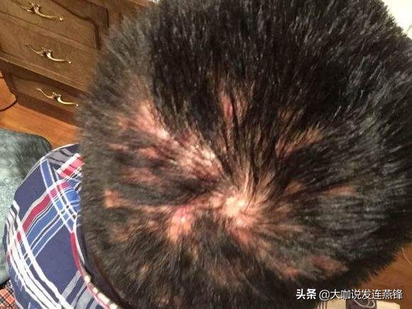 植发后毛囊炎怎么彻底根治,植发后出现毛囊炎吃什么中成药