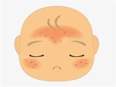 秋冬季节总是起湿疹是怎么回事,每年春季都会过敏性湿疹怎么回事