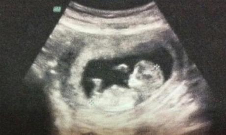 流产的胎儿是活的怎么处理,医院如何知道自己的流产情况