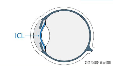 近视飞秒和icl晶体哪个好,全飞秒和icl哪个危害大