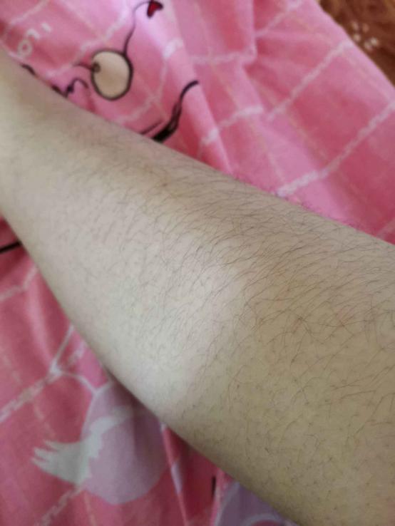 有体毛的女生要脱毛吗,体毛少可以不刮毛直接冰点脱毛吗