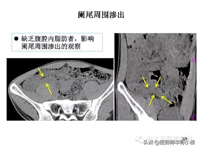 阑尾炎课件,阑尾炎的超声课件