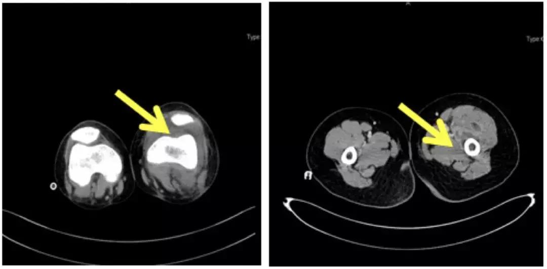 万古霉素用于mrsa的作用机制,万古霉素无效还有什么抗生素可用